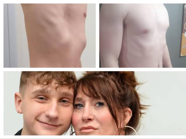 Jacob with his mum Rachel Ferguson and the photos which show his chest in 2022 - and how it looks now.