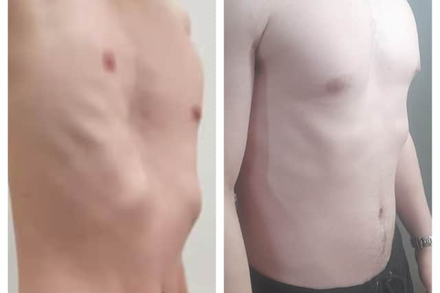 How Jacob's chest looked before the operation and how it looks now as he prepares for one final surgery.