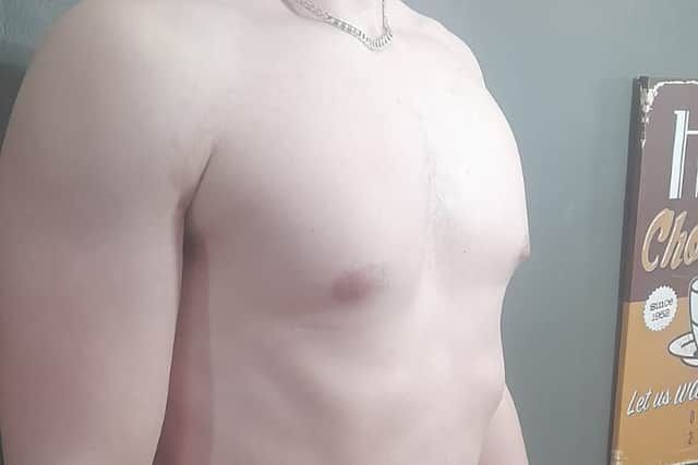Jacob Ferguson as he looks today, just days before the operation to remove the metal bar from his chest.