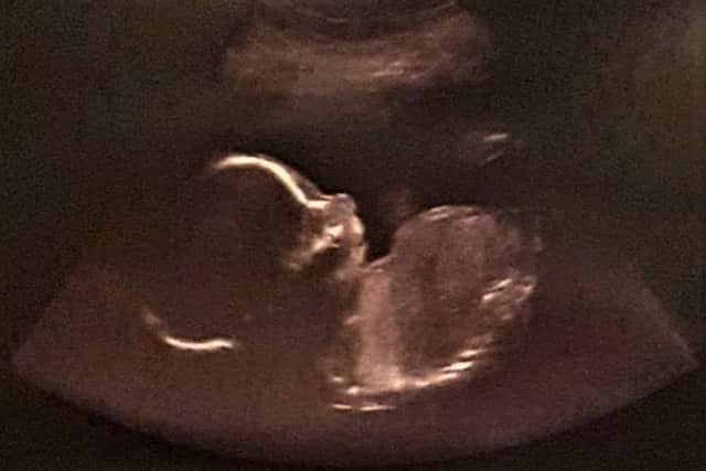 A scan of Rob and Kimberley Allen's baby boy.