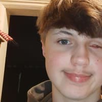 Hartlepool teenager's firework warning to others after losing an eye in horror accident