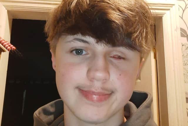 Aleks is warning others about the dangers of fireworks after his accident in 2024.
