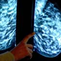 Breast cancer screening fears.
