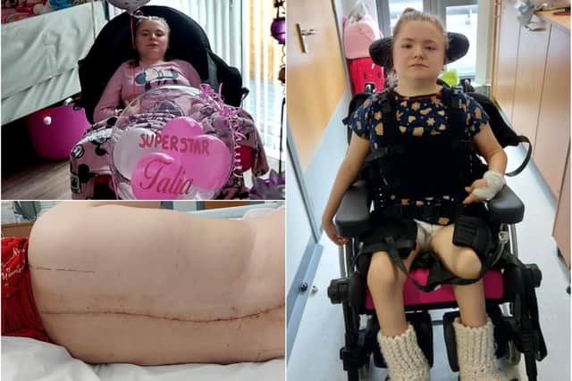 Talia Foster who has undergone a 9-hour operation to help correct a curvature of her spine.
