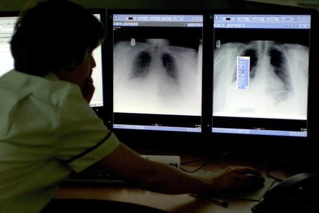 Two TB cases a year are being recorded in Hartlepool