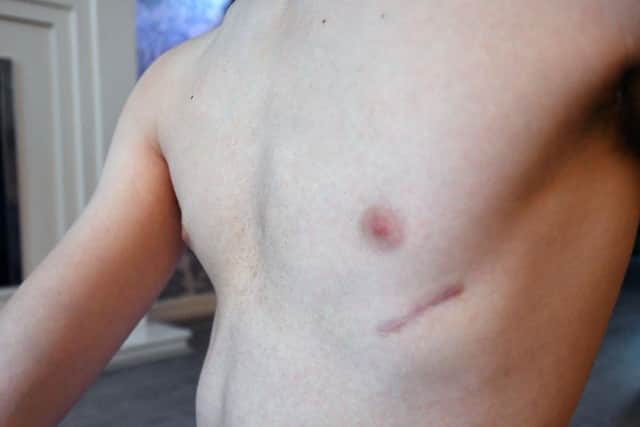 Joshua Readman showing the scar on the left side of his chest. Picture by FRANK REID