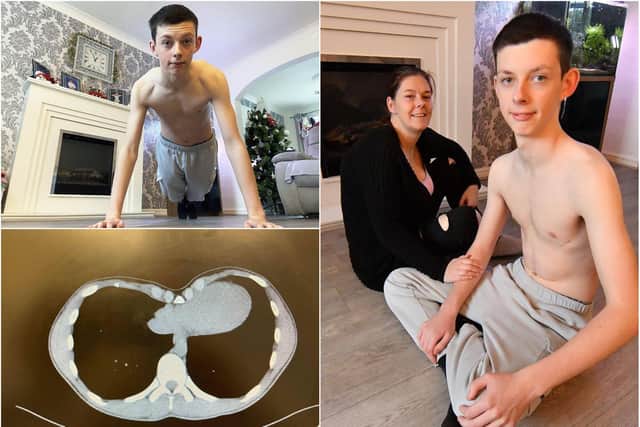 Joshua Readman who has fought back to fitness after a £10,000 operation to have a metal bar inserted into his chest.