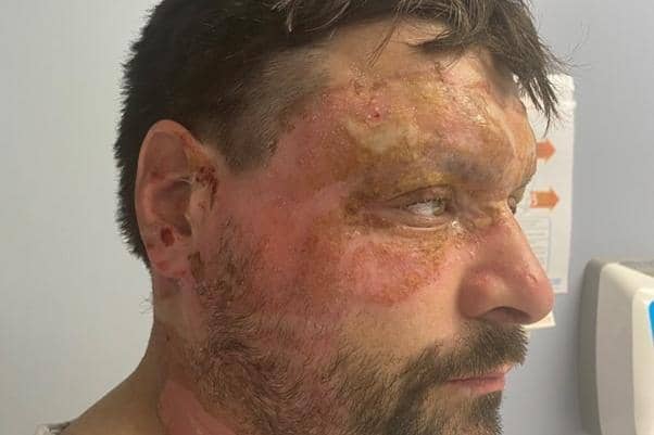 Carl Lowery after suffering serious burns while at work.