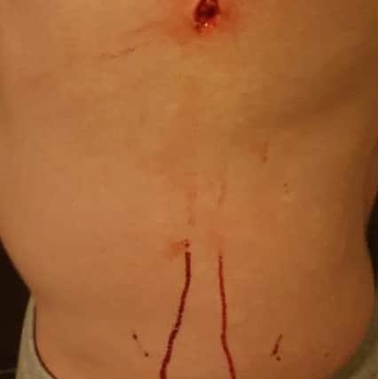 Alan Callander's stab wound he suffered when challenging a crook in his mum Jackie Callander's car.