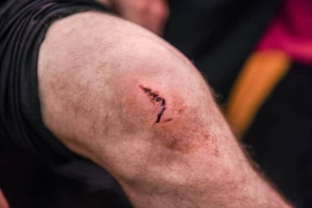 Injury caused to Ian Fewster's knee by a claw hammer.