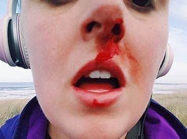 Sarah Tough's face following the attack at Crimdon.