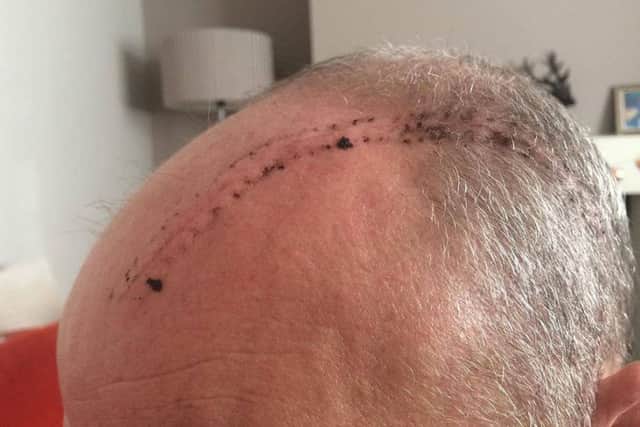 Mark had 47 staples in his head after his operation